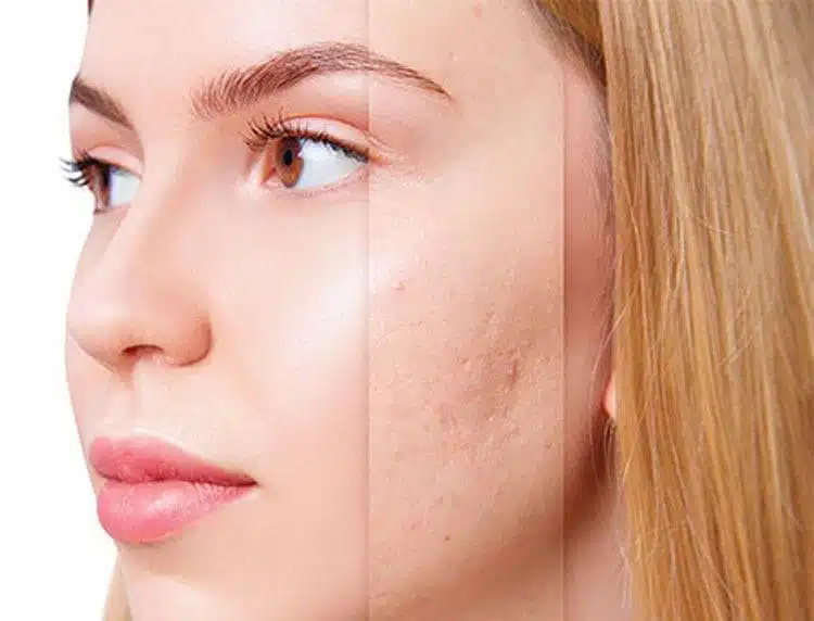 کرم آزلائیک اسید ۱۰% اوردینری Theordinary