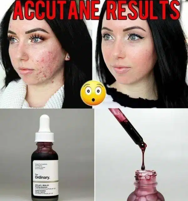 پیلینگ اوردینری Peeling Solution