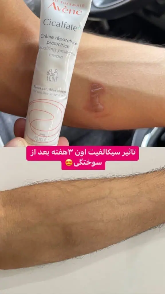 تاثیر سیکافلت اون بعد از مصرف